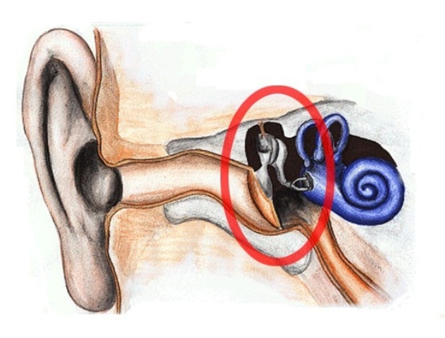 barotrauma ear drips