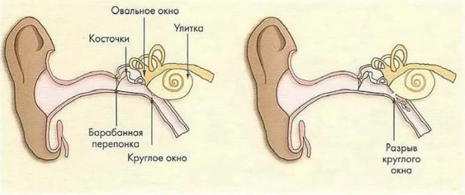 ear barotrauma surgery
